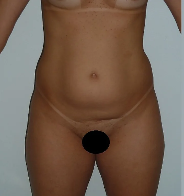 Antes: abdominoplastia