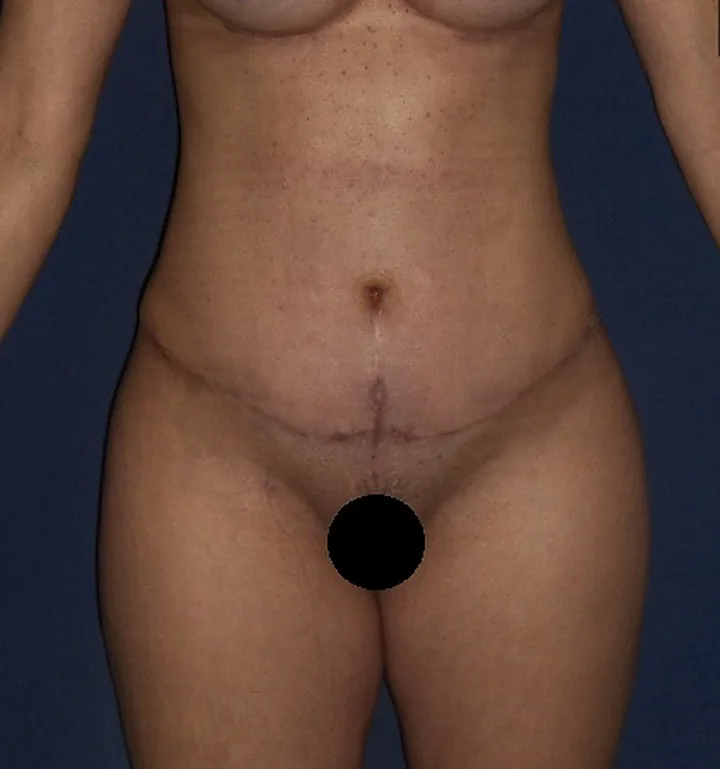 Depois: abdominoplastia, 1 mês de pós-operatório