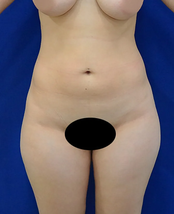 Antes: lipoaspiração