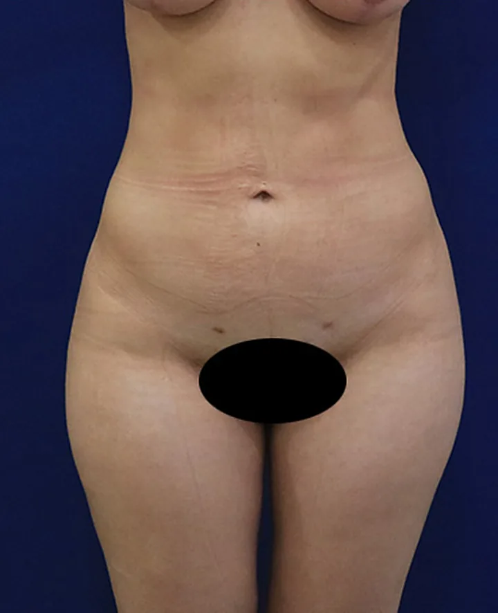 Depois: lipoaspiração, 3 meses de pós-operatório