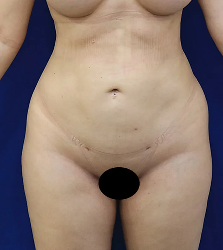 Depois: lipoaspiração, 6 meses de pós-operatório
