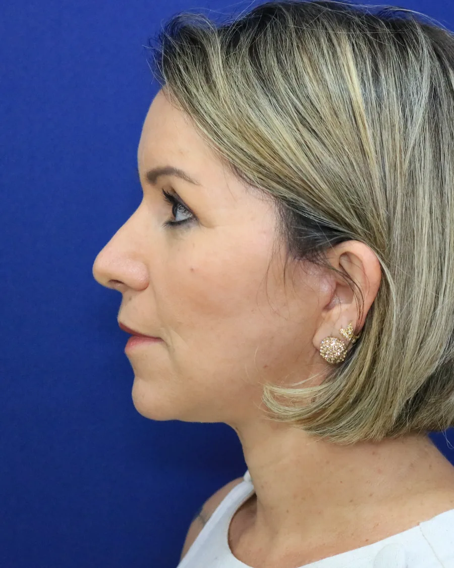 Depois: lifting facial, perfil