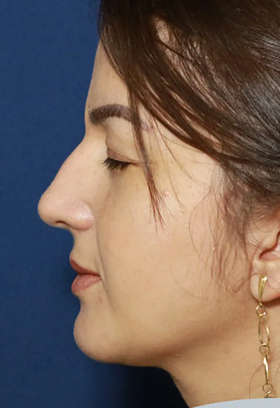 Antes: rinoplastia, perfil