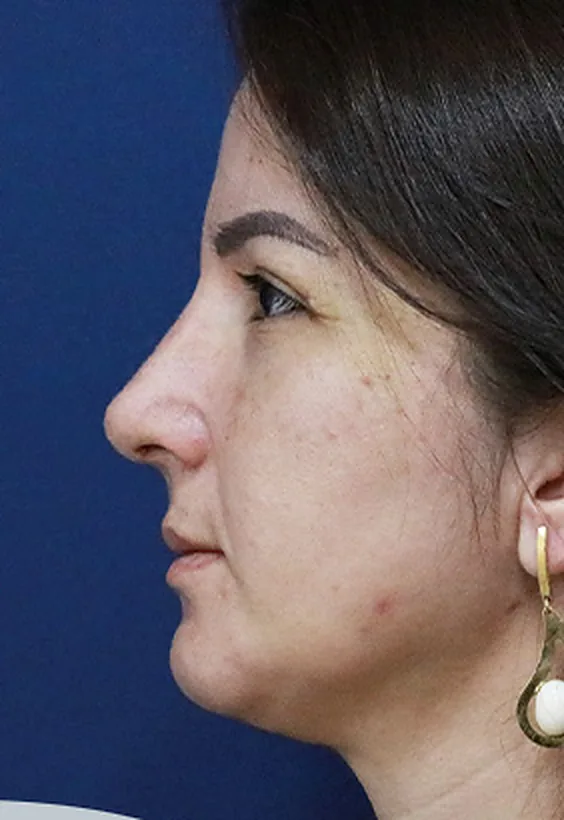 Depois: rinoplastia, 2 meses de pós-operatório, perfil