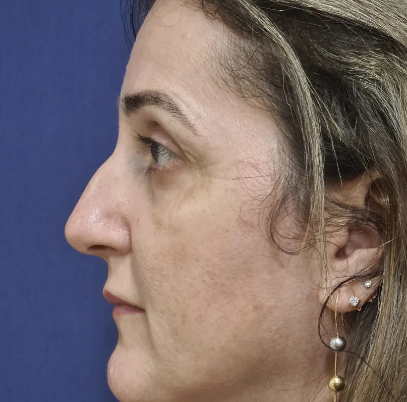 Antes: rinoplastia, perfil