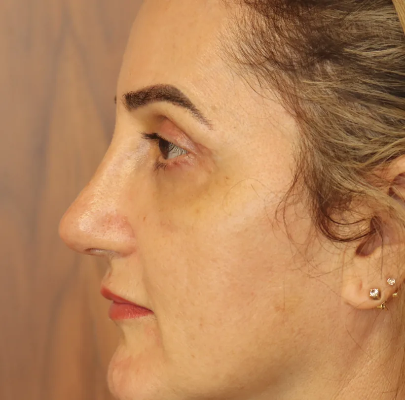 Depois: rinoplastia, 3 semanas de pós-operatório, perfil